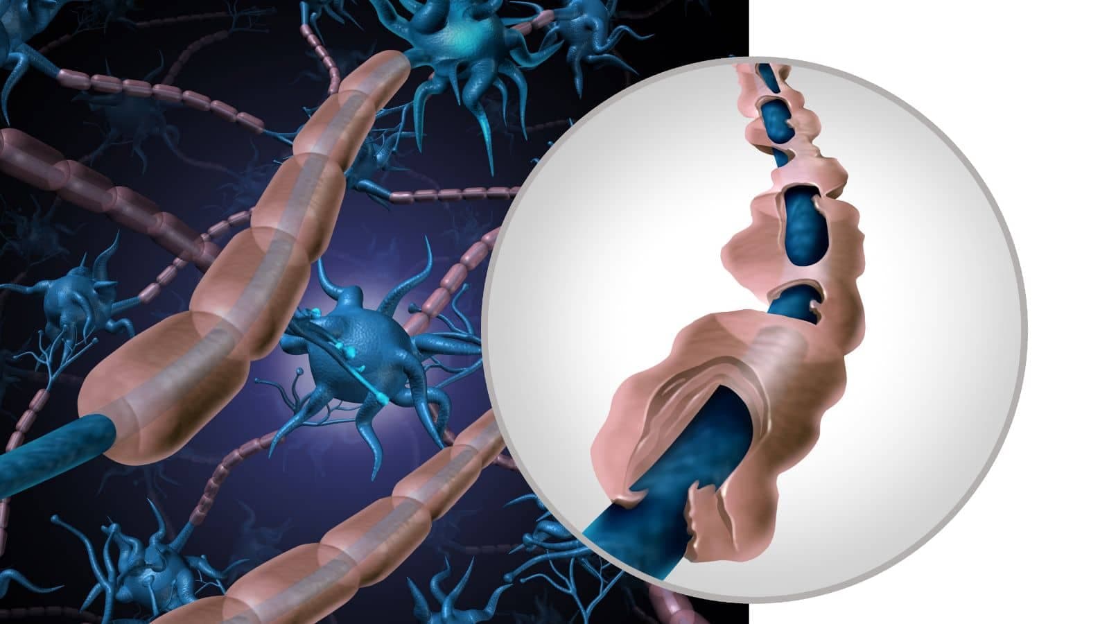 Esclerosis Múltiple